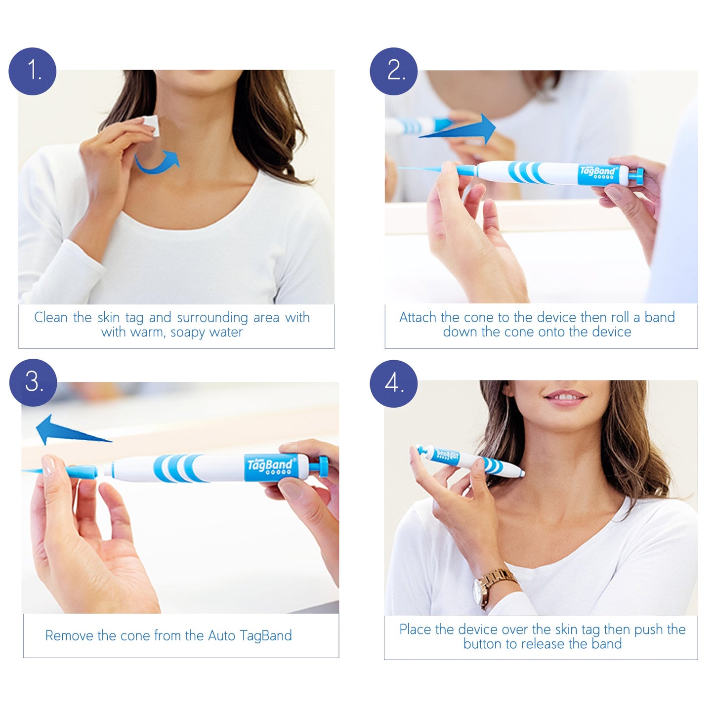 TagBand Skin Tag Remover