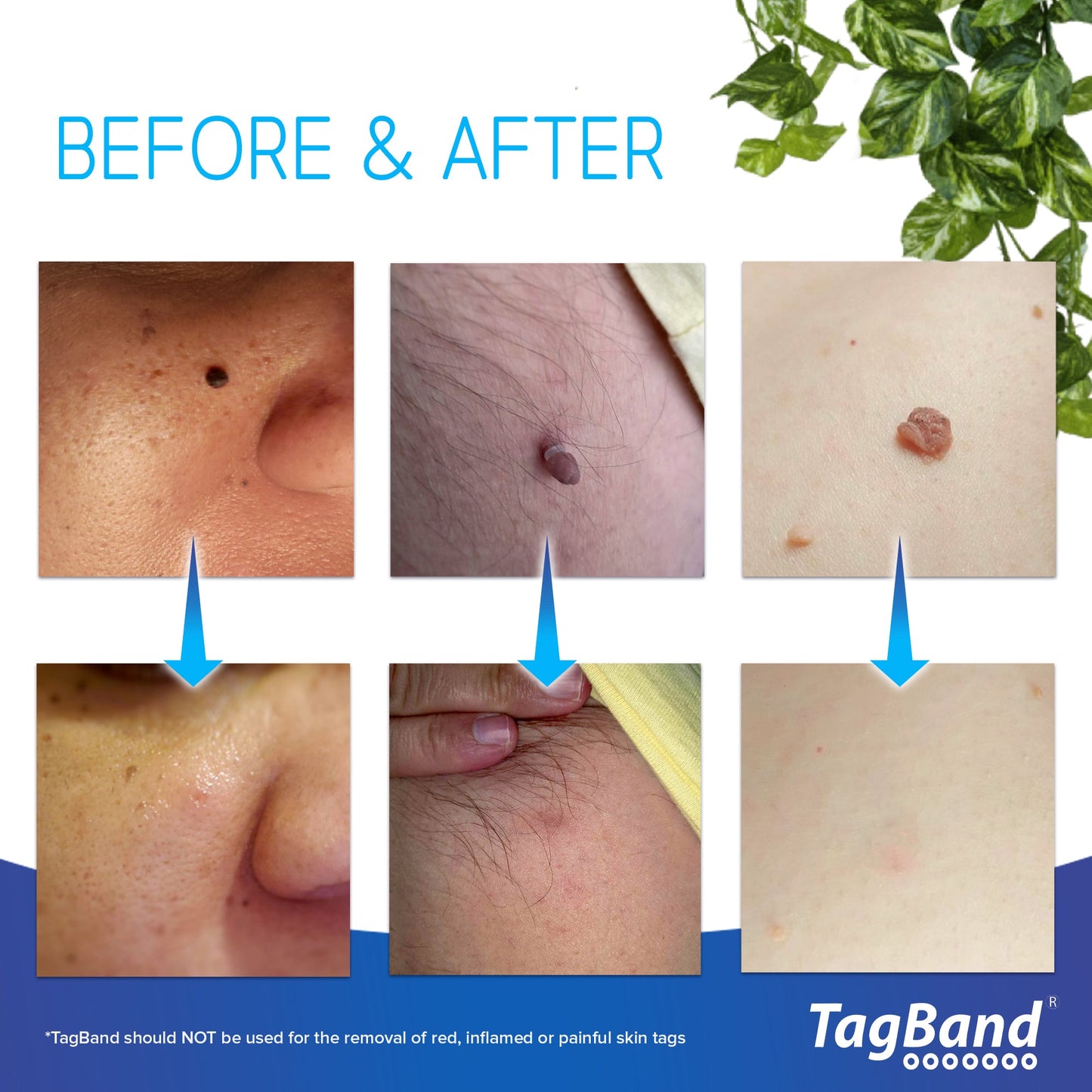 TagBand Skin Tag Remover